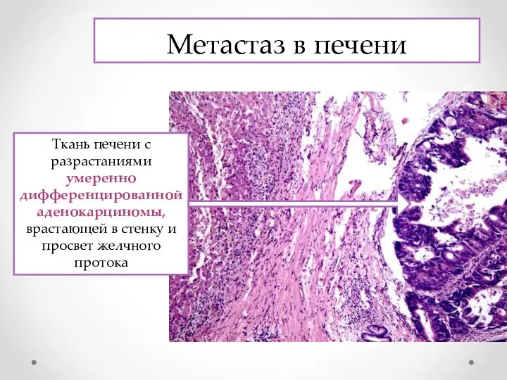Метастаз в печени Ткань печени с разрастаниями умеренно дифференцированной аденокарциномы,