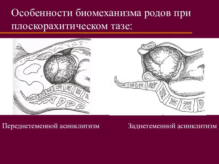 Особенности биомеханизма родов при плоскорахитическом тазе: Переднетеменной асинклитизм Заднетеменной асинклитизм