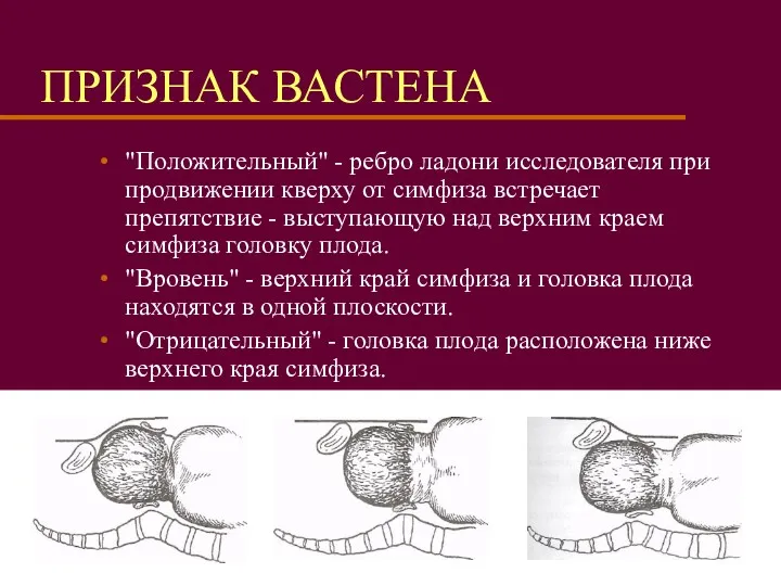 ПРИЗНАК ВАСТЕНА "Положительный" - ребро ладони исследователя при продвижении кверху