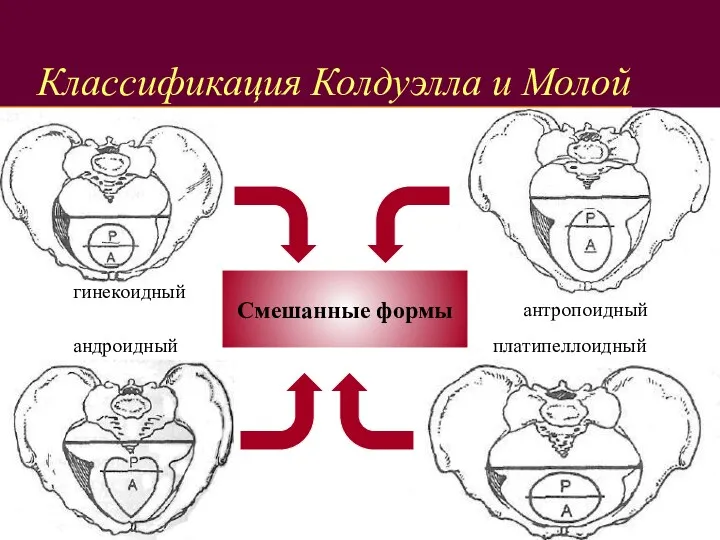 Классификация Колдуэлла и Молой гинекоидный андроидный платипеллоидный антропоидный Смешанные формы