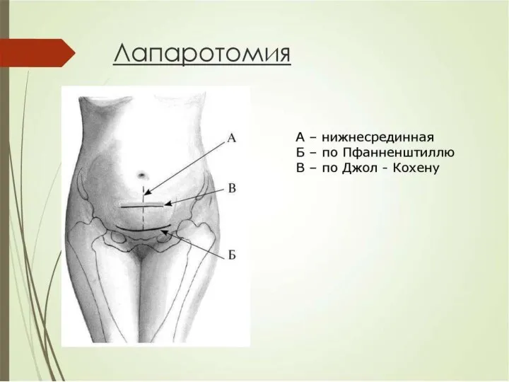 Лапаротомия по Пфанненштилю Лапаротомия по Джоэль-Кохену