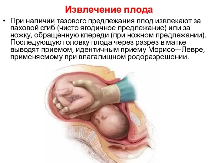 Извлечение плода При наличии тазового предлежания плод извлекают за паховой