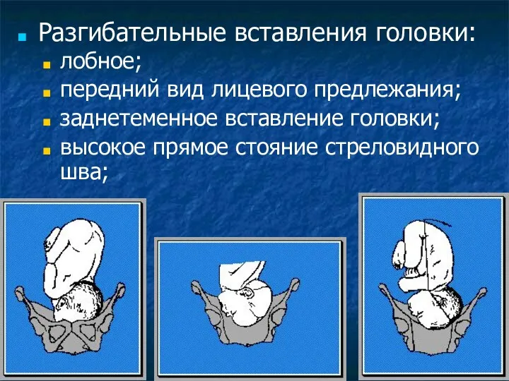 Разгибательные вставления головки: лобное; передний вид лицевого предлежания; заднетеменное вставление головки; высокое прямое стояние стреловидного шва;