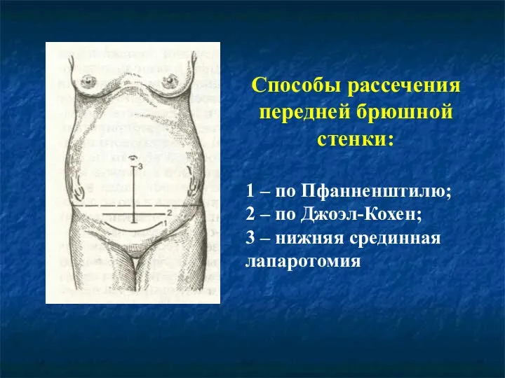 Способы рассечения передней брюшной стенки: 1 – по Пфанненштилю; 2