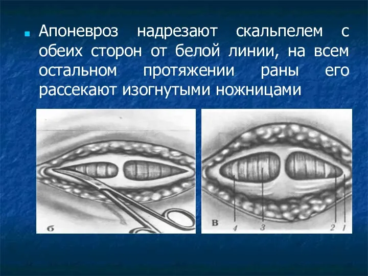 Апоневроз надрезают скальпелем с обеих сторон от белой линии, на