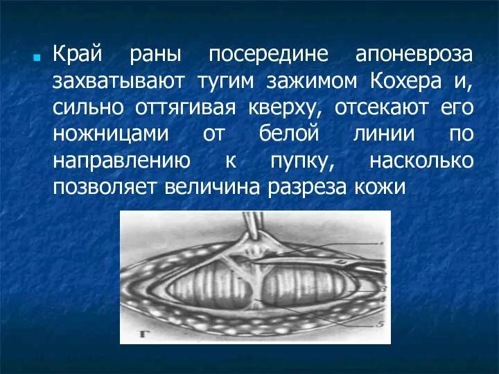 Край раны посередине апоневроза захватывают тугим зажимом Кохера и, сильно