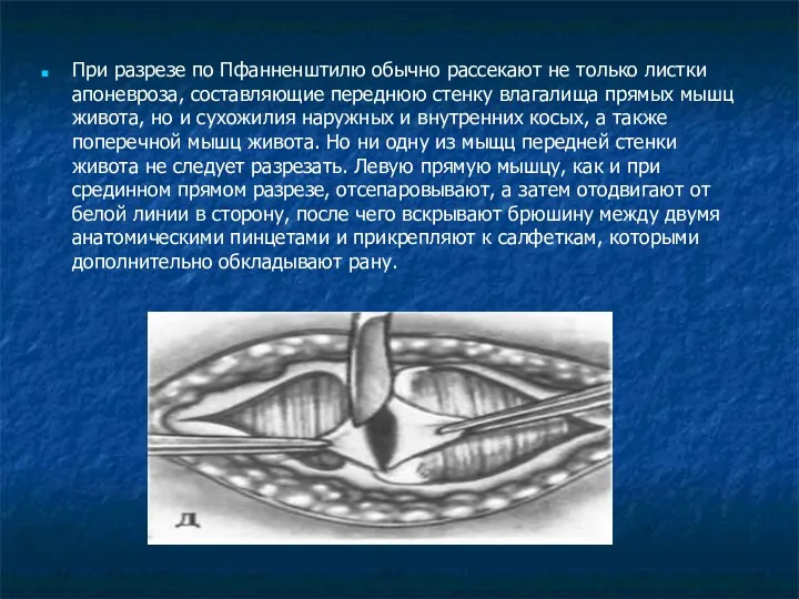 При разрезе по Пфанненштилю обычно рассекают не только листки апоневроза,