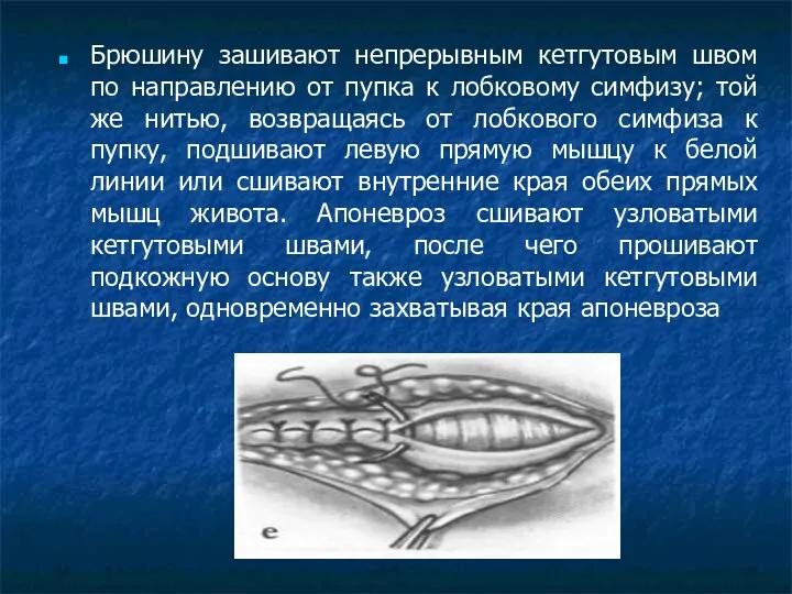 Брюшину зашивают непрерывным кетгутовым швом по направлению от пупка к