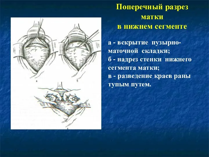 Поперечный разрез матки в нижнем сегменте а - вскрытие пузырно-маточной