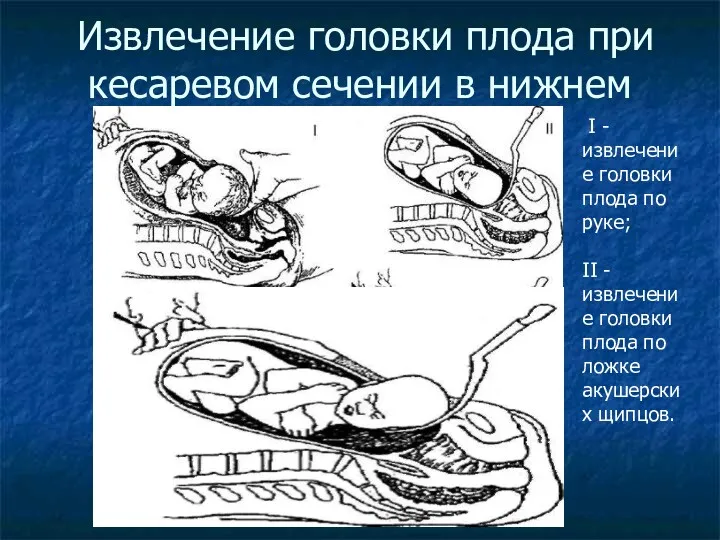 Извлечение головки плода при кесаревом сечении в нижнем маточном сегменте: