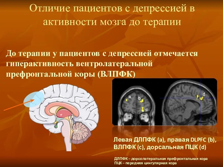 Отличие пациентов с депрессией в активности мозга до терапии До