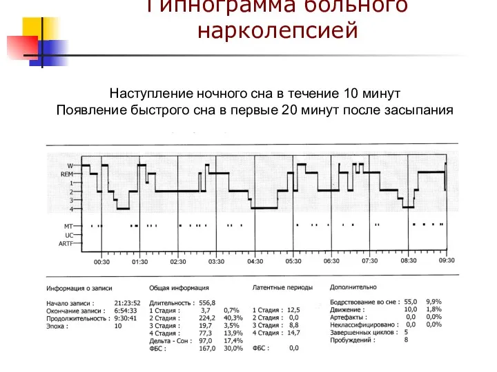 Гипнограмма больного нарколепсией Наступление ночного сна в течение 10 минут Появление быстрого сна