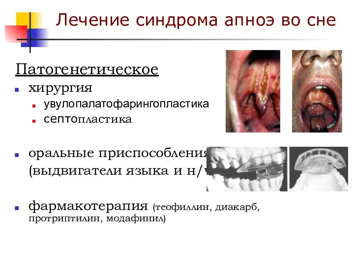 Патогенетическое хирургия увулопалатофарингопластика септопластика оральные приспособления (выдвигатели языка и н/ч) фармакотерапия (теофиллин, диакарб,