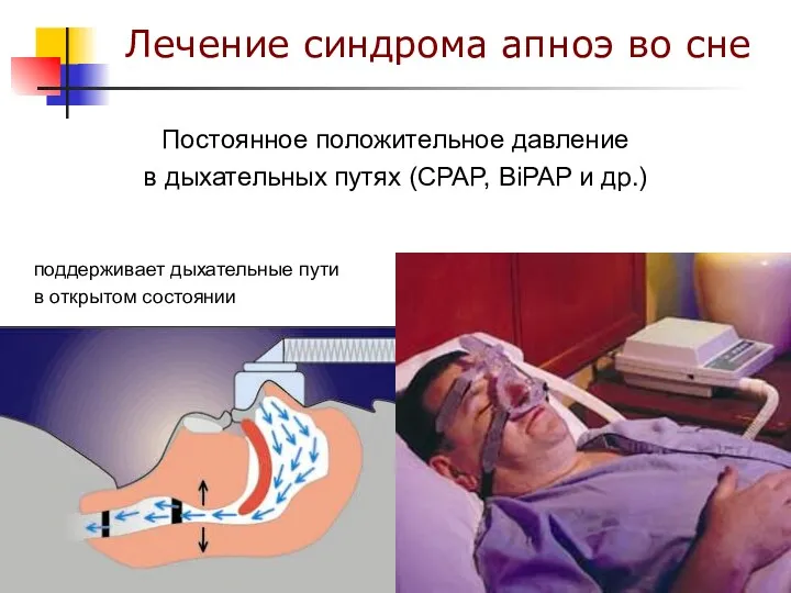 Постоянное положительное давление в дыхательных путях (CPAP, BiPAP и др.) Лечение синдрома апноэ