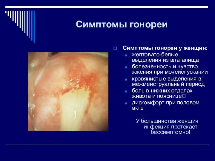 Симптомы гонореи Симптомы гонореи у женщин: желтовато-белые выделения из влагалища