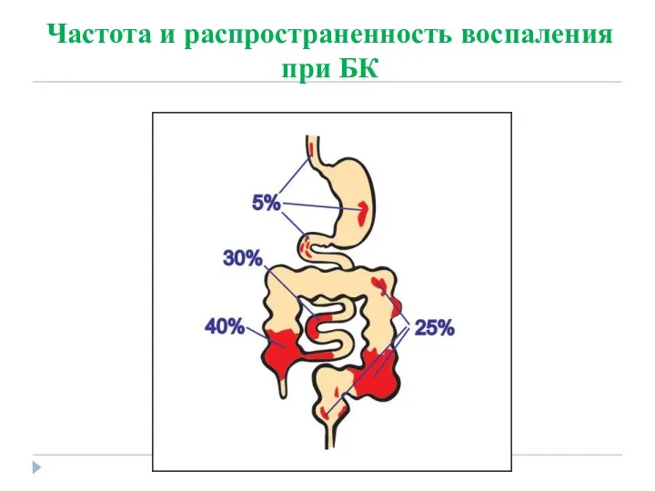 Частота и распространенность воспаления при БК