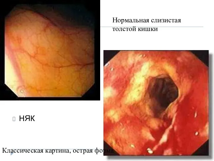 НЯК Нормальная слизистая толстой кишки Классическая картина, острая форма