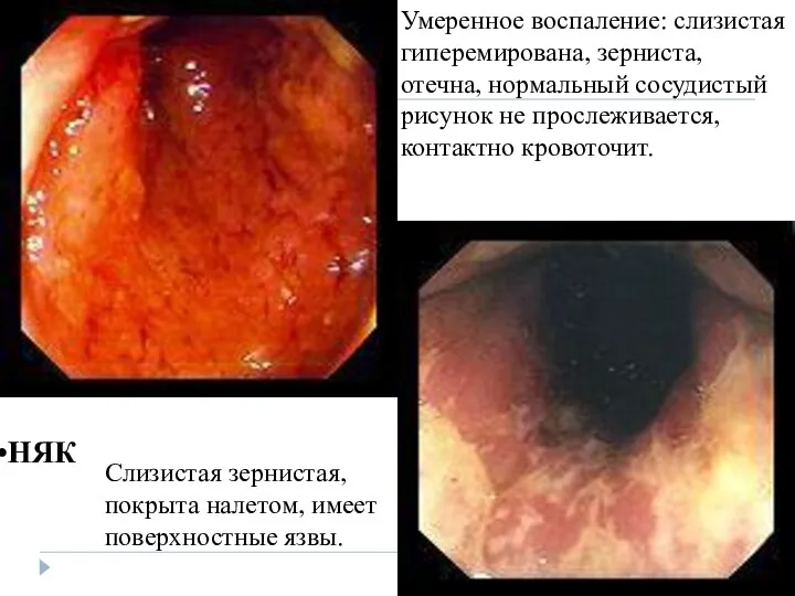 Умеренное воспаление: слизистая гиперемирована, зерниста, отечна, нормальный сосудистый рисунок не