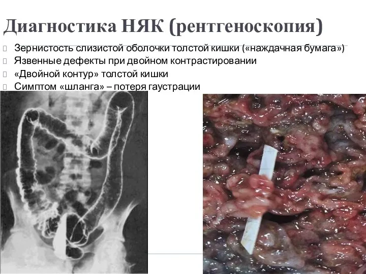 Диагностика НЯК (рентгеноскопия) Зернистость слизистой оболочки толстой кишки («наждачная бумага»)