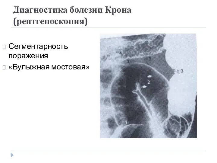 Диагностика болезни Крона (рентгеноскопия) Сегментарность поражения «Булыжная мостовая»