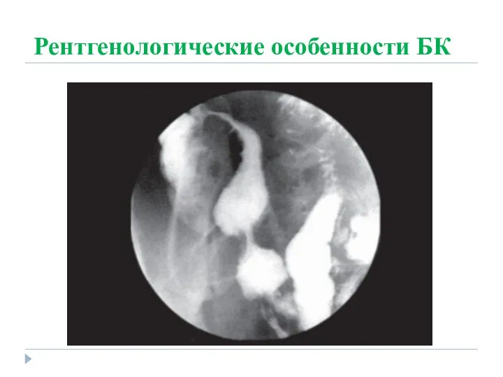 Рентгенологические особенности БК