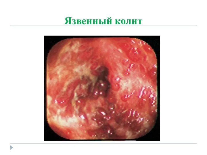 Язвенный колит
