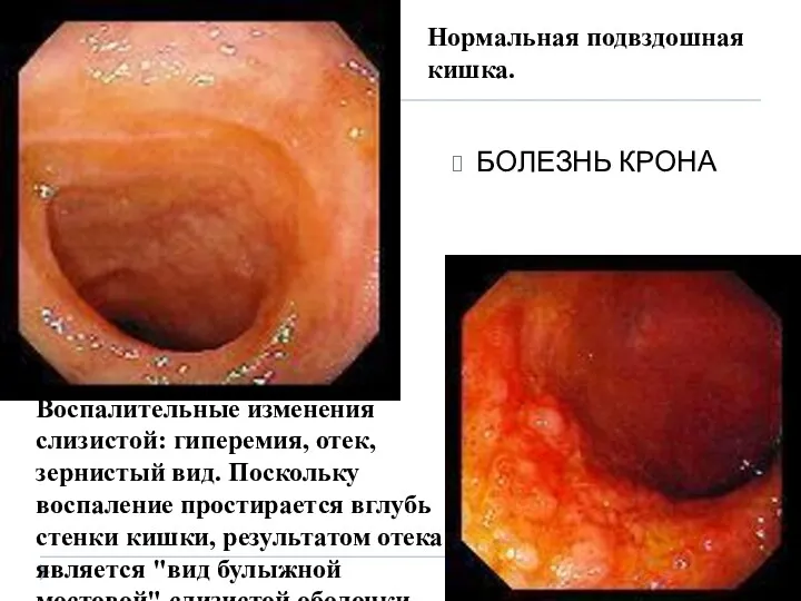 БОЛЕЗНЬ КРОНА Нормальная подвздошная кишка. Воспалительные изменения слизистой: гиперемия, отек,