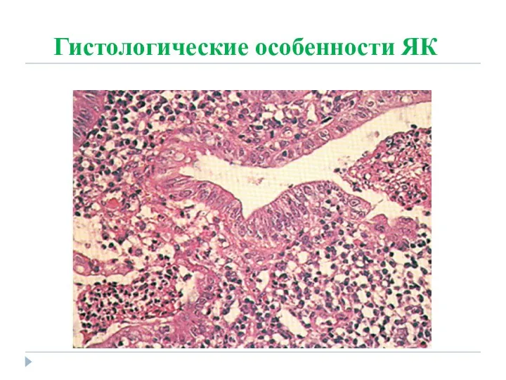 Гистологические особенности ЯК