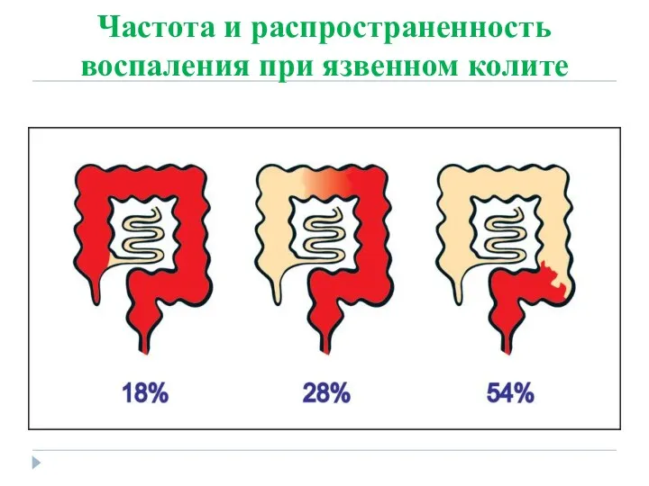 Частота и распространенность воспаления при язвенном колите