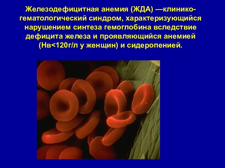 Железодефицитная анемия (ЖДА) —клинико- гематологический синдром, характеризующийся нарушением синтеза гемоглобина вследствие дефицита железа