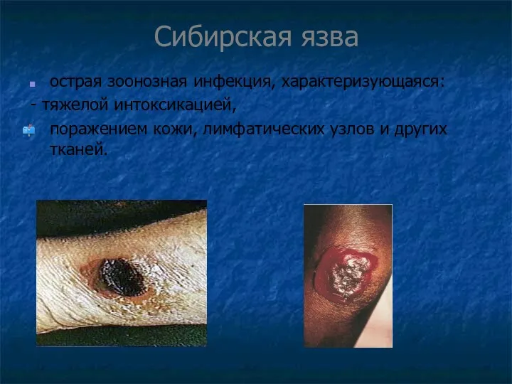 Сибирская язва острая зоонозная инфекция, характеризующаяся: - тяжелой интоксикацией, поражением кожи, лимфатических узлов и других тканей.