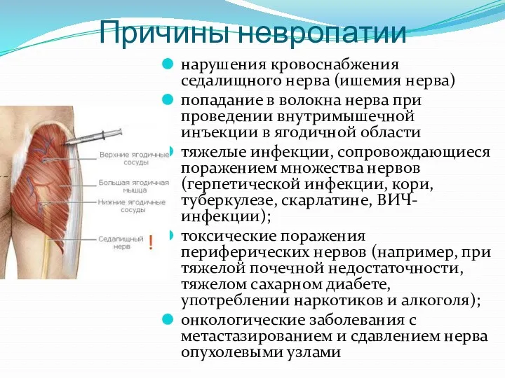 Причины невропатии нарушения кровоснабжения седалищного нерва (ишемия нерва) попадание в