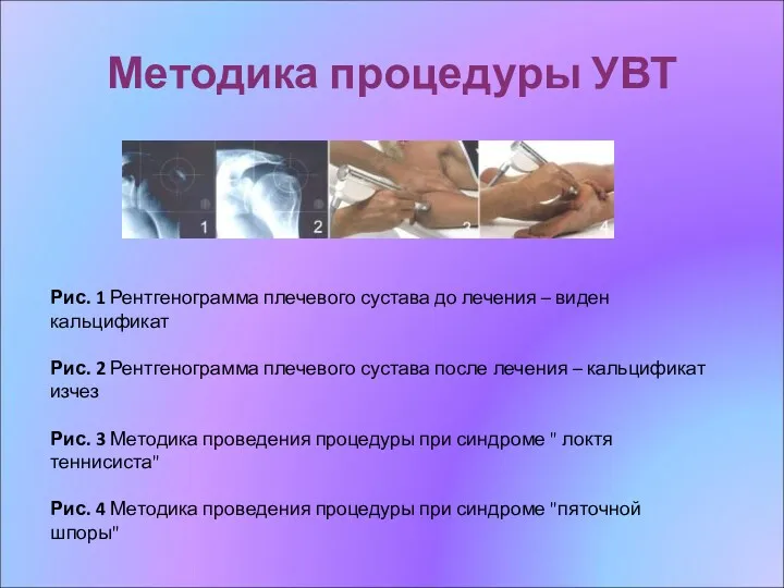 Методика процедуры УВТ Рис. 1 Рентгенограмма плечевого сустава до лечения