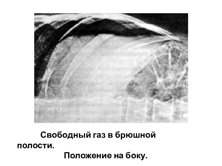 Свободный газ в брюшной полости. Положение на боку.