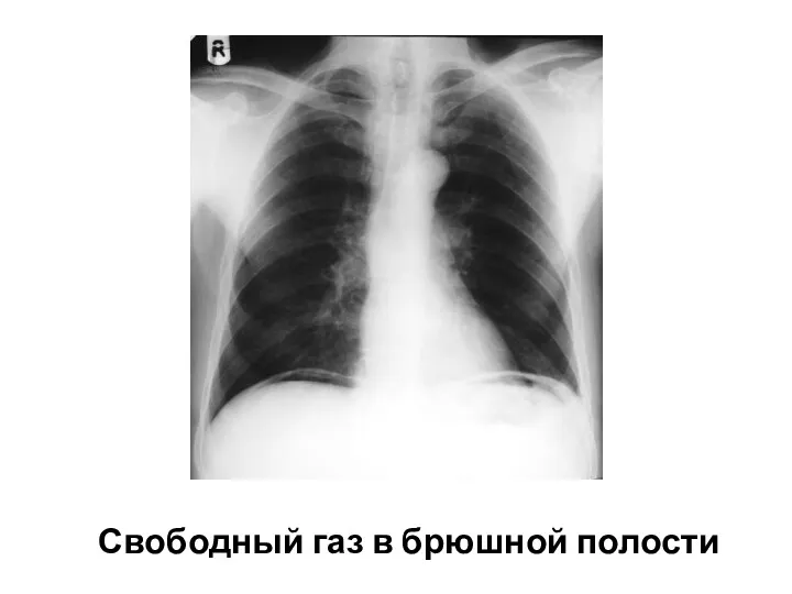 Свободный газ в брюшной полости