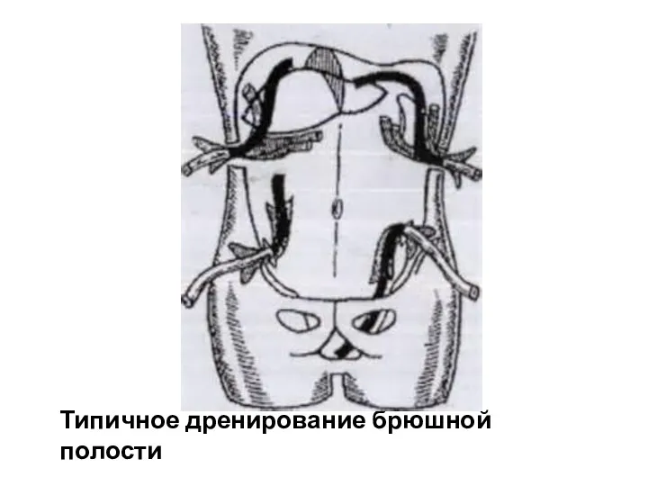 Типичное дренирование брюшной полости