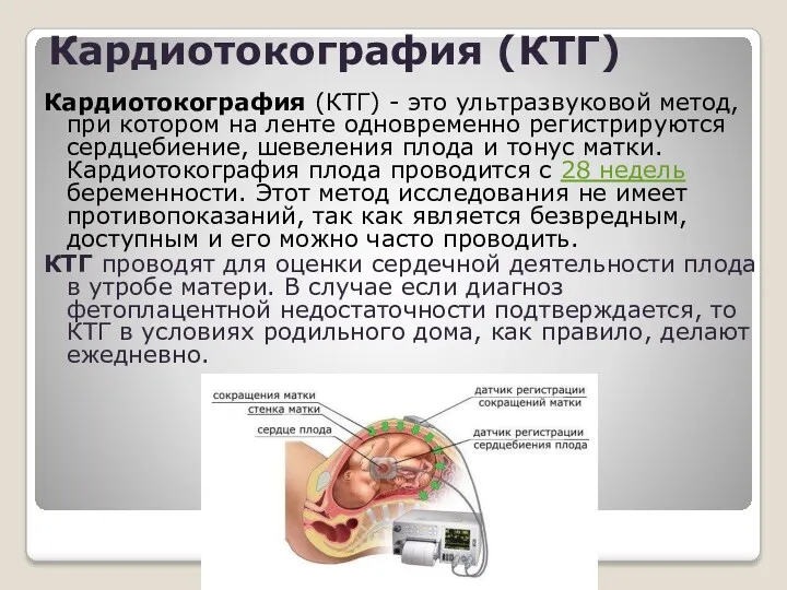 Кардиотокография (КТГ) Кардиотокография (КТГ) - это ультразвуковой метод, при котором на ленте одновременно