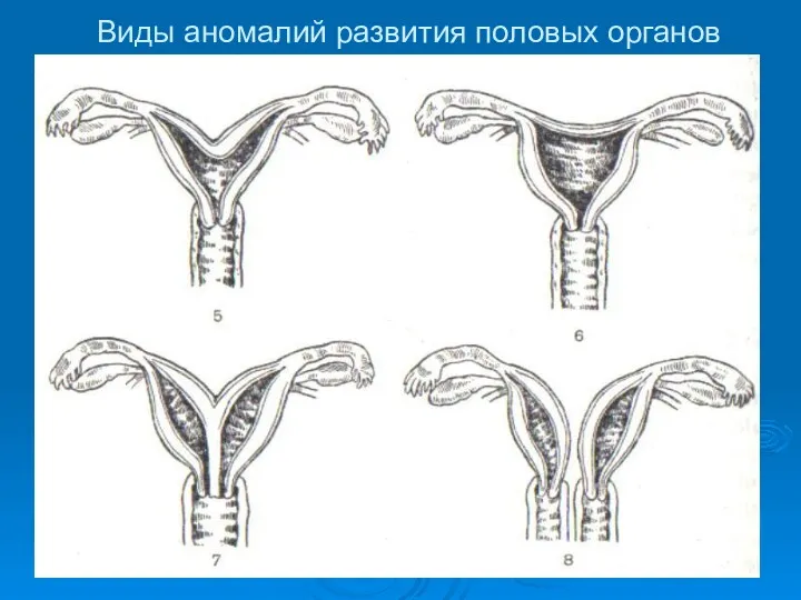 Виды аномалий развития половых органов