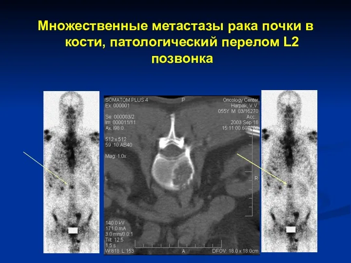 Множественные метастазы рака почки в кости, патологический перелом L2 позвонка