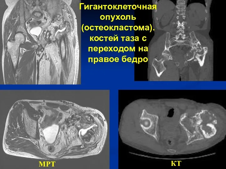 МРТ КТ Гигантоклеточная опухоль (остеокластома). костей таза с переходом на правое бедро