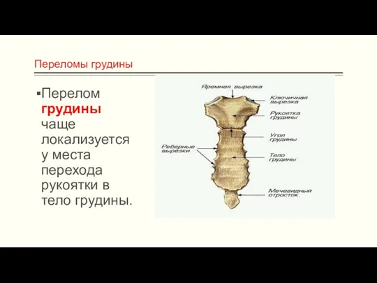 Переломы грудины Перелом грудины чаще локализуется у места перехода рукоятки в тело грудины.