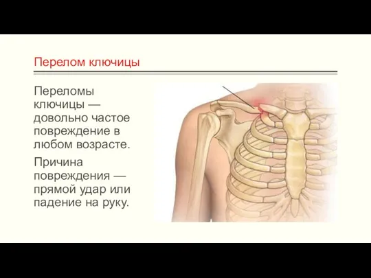 Перелом ключицы Переломы ключицы — довольно частое повреждение в любом