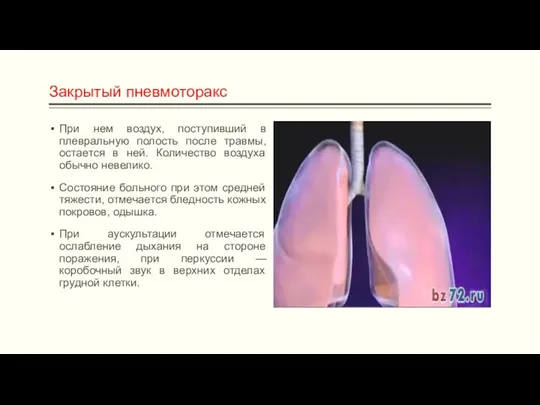 Закрытый пневмоторакс При нем воздух, поступивший в плевральную полость после