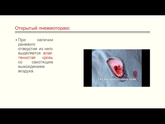 Открытый пневмоторакс При наличии раневого отверстия из него выделяется алая пенистая кровь со свистящим выхождением воздуха.