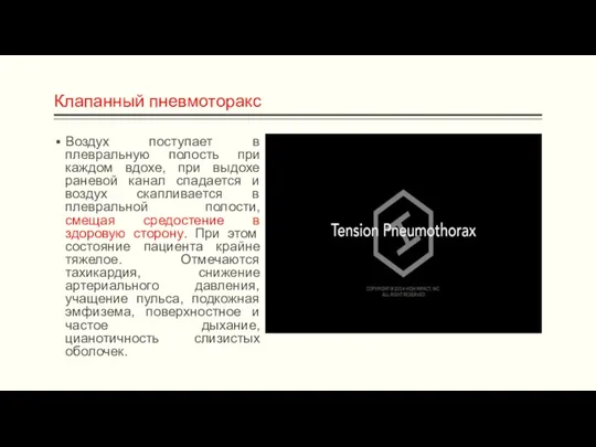 Клапанный пневмоторакс Воздух поступает в плевральную полость при каждом вдохе, при выдохе раневой