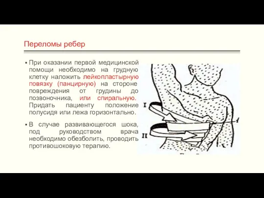 Переломы ребер При оказании первой медицинской помощи необходимо на грудную