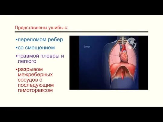 Представлены ушибы с: переломом ребер со смещением травмой плевры и легкого разрывом межреберных