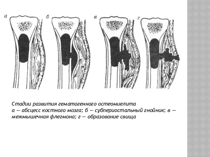 Стадии развития гематогенного остеомиелита а — абсцесс костного мозга; б — субпериостальный гнойник;