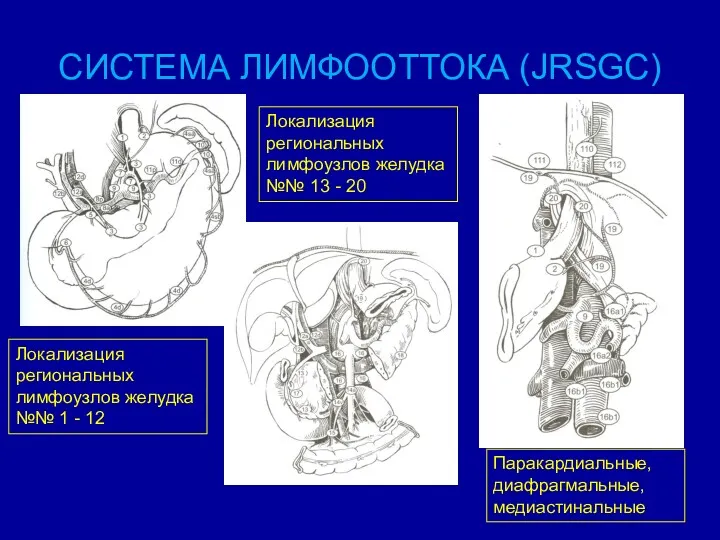 СИСТЕМА ЛИМФООТТОКА (JRSGC) Локализация региональных лимфоузлов желудка №№ 1 -