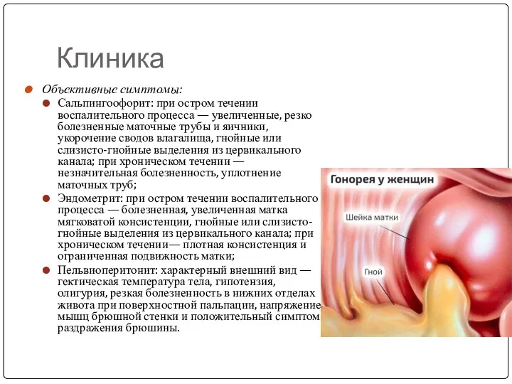 Клиника Объективные симптомы: Сальпингоофорит: при остром течении воспалительного процесса —